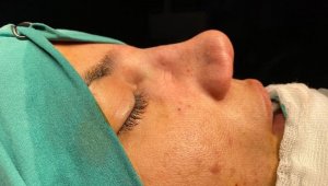 Burun estetiği kabusu oldu