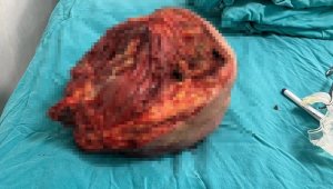 Kalçasındaki dev tümör görenleri hayrete düşürdü