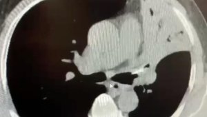 Öksürük şikayetiyle gittiği hastanede 5 yıldır akciğerinde lades kemiğiyle yaşadığını öğrendi