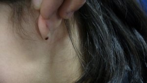 Kulağına kene yapışan küçük çocuk hastaneye kaldırıldı